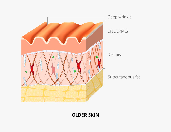OLDER SKIN : Deep wrinkle, EPIDERMIS, Dermis, Subcutaneous fat